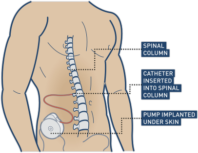 Baclofen SCIRE Community