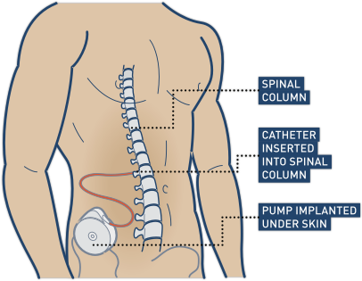 Cartoon diagram of a man's body with a disc-shaped intrathecal pump implanted under the skin with a red wire catheter inserted into the spinal column
