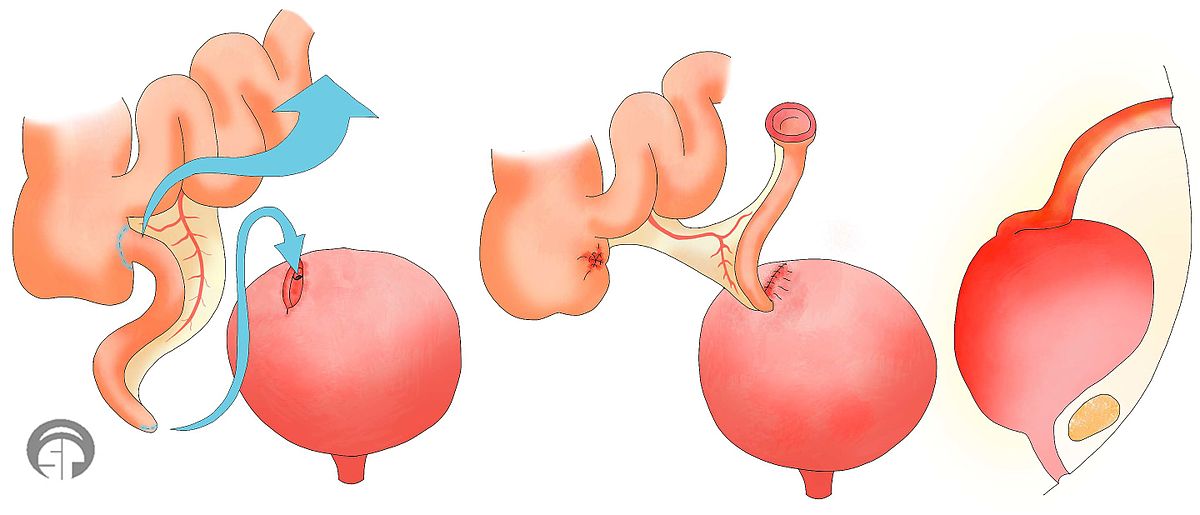 A cartoon diagram of the surgical Mitrofanoff procedure, taking the appendix and connecting it to the bladder.