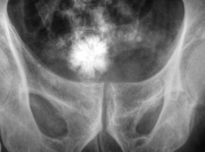 X-ray of a large bladder stone