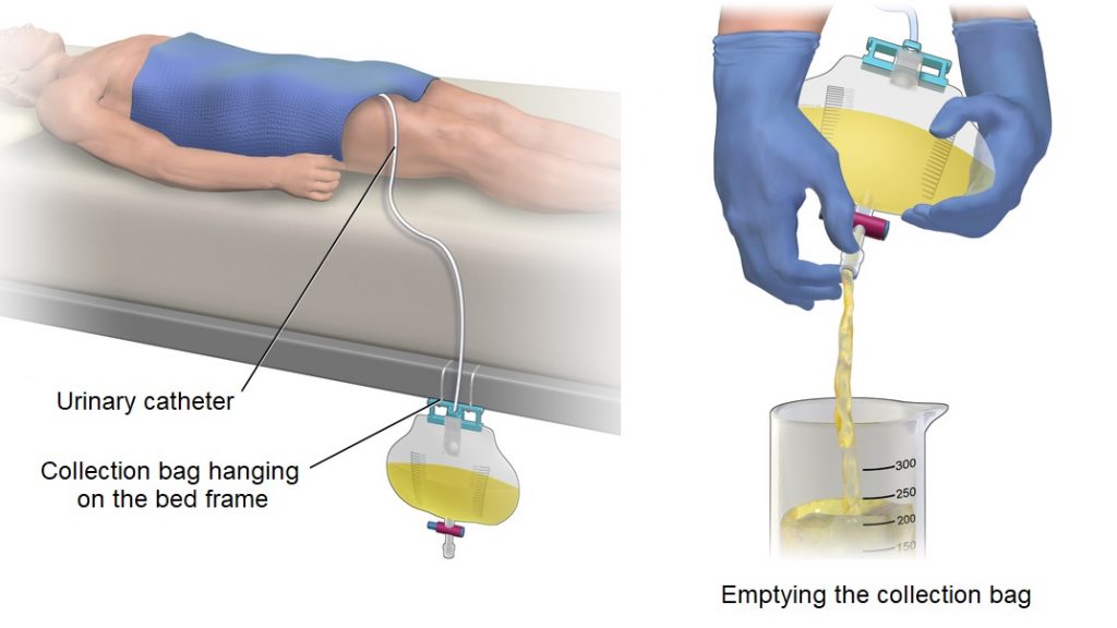 Urinary Catheters - SCIRE Community