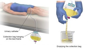 A person lying down on a bed with a urinary catheter and collection bag hanging on the bed frame (left). Emptying the collection bag into a glass beaker (right).
