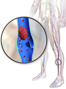 Diagram showing a clot in a leg vein leading to DVT
