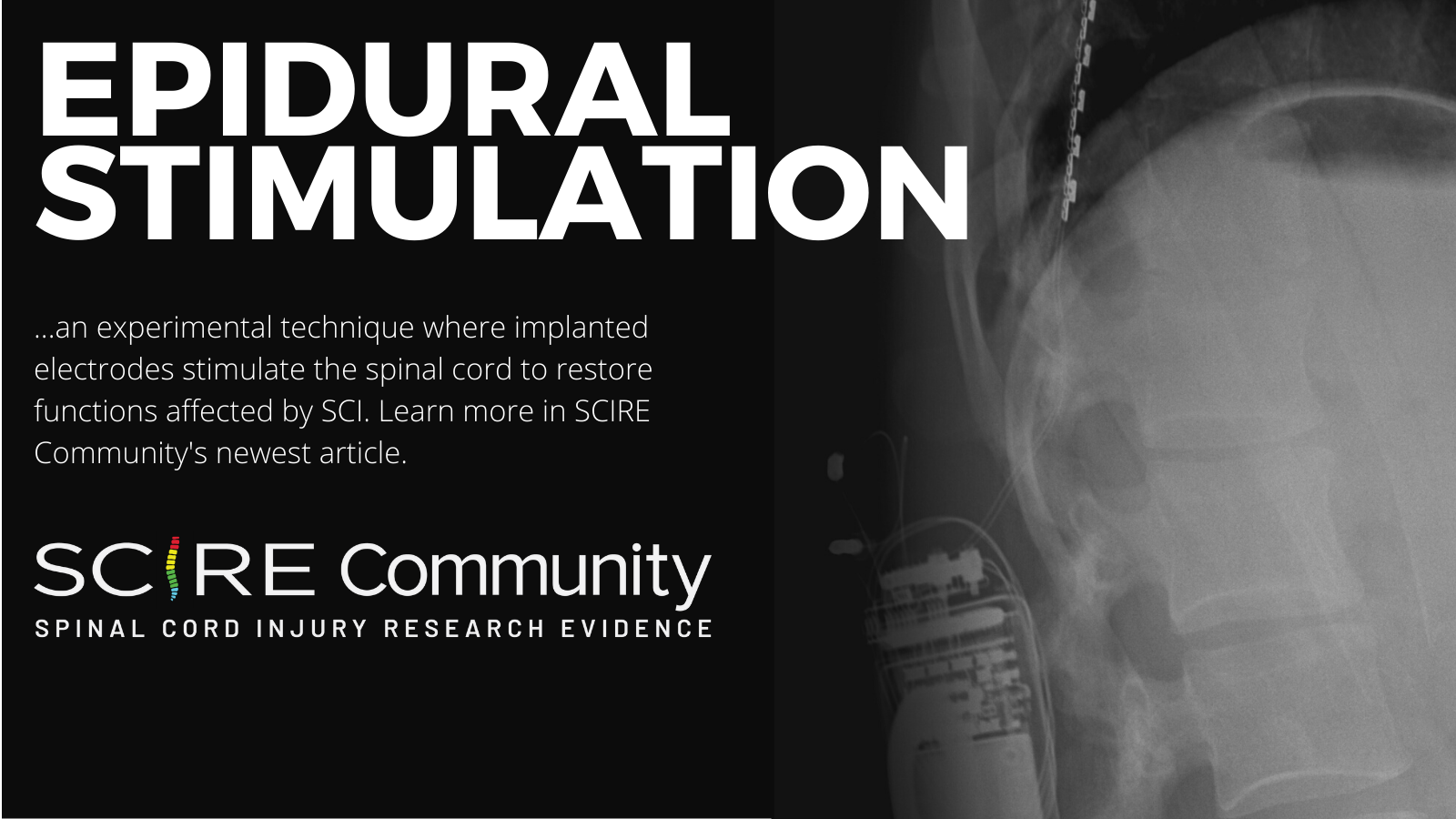 X-ray image: spine with wires and electrodes in the spinal cord on a black background White text on black background: Epidural stimulation ...an experimental technique where implanted electrodes stimulate the spinal cord to restore functions affected by SCI. Learn more in SCIRE Community's newest article. SCIRE Community logo Spinal Cord Injury Research Evidence