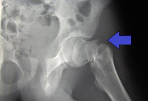 X-ray image of a hip fracture