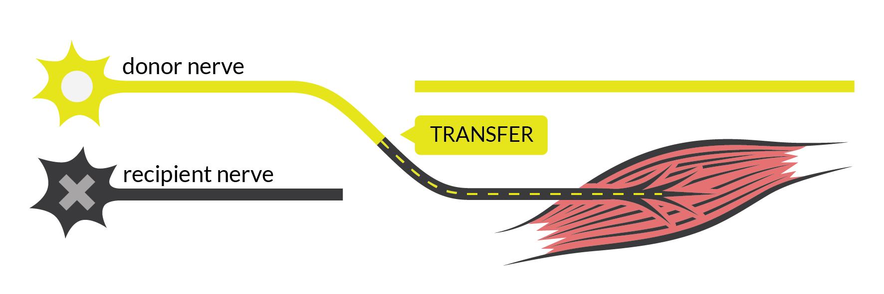 Nerve Transfer Surgery - SCIRE Community