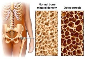 Diagram comparing bone with normal bone mineral density to bone with osteoporosis.