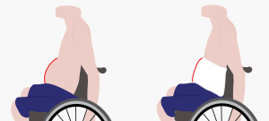 A profile of a man on a wheelchair with a protruded belly on the left. A profile of a man on a wheelchair with a flattened belly wearing an abdominal binder on the right.