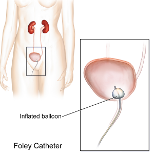 A thin tube (catheter) is shown travelling up the urethra to the bladder. A zoom in image shows a small balloon that is inflated to hold the tube in place.
