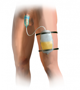Image of a condom catheter. A condom-like bag is held over the penis which drains through a tube to a urine bag strapped to the thigh.