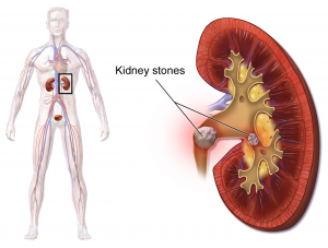 Left image is of a person's body with two kidneys located in the mid abdomen. Enlargement on right shows a bean-shaped kidney with a piece of mineral (labelled 'kidney stones') located at the exit of the kidney,
