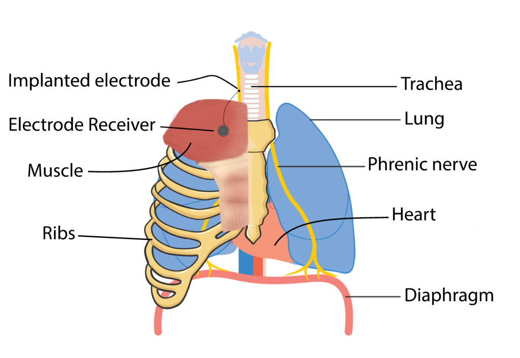 Respiratory Changes After Spinal Cord Injury - SCIRE Community