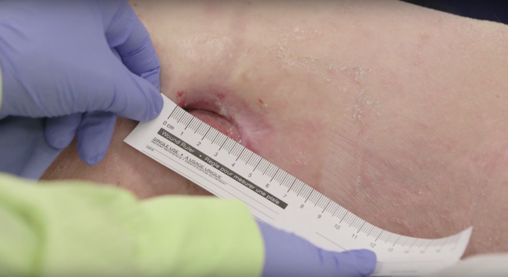 Image Credit 7. Image by SCIRE Community Team A light pink open wound with a disposable medical ruler held against it to measure the wound length by someone wearing gloves and a gown